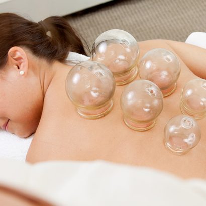 Woman on bed receiving acupunture using cupping technique.
